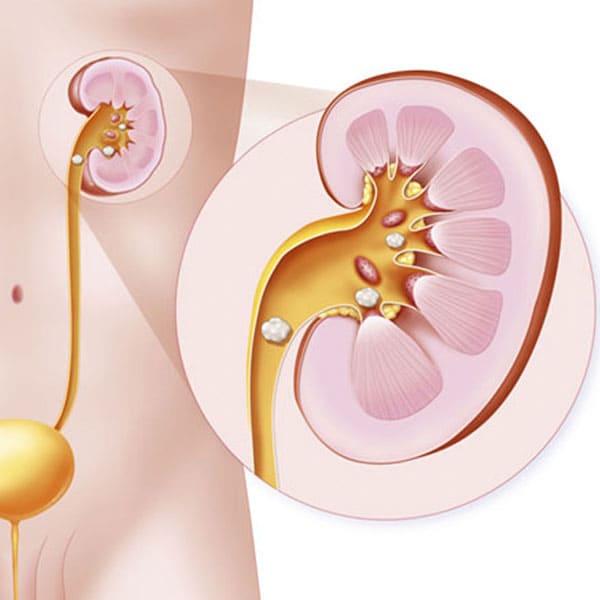liatisis renal