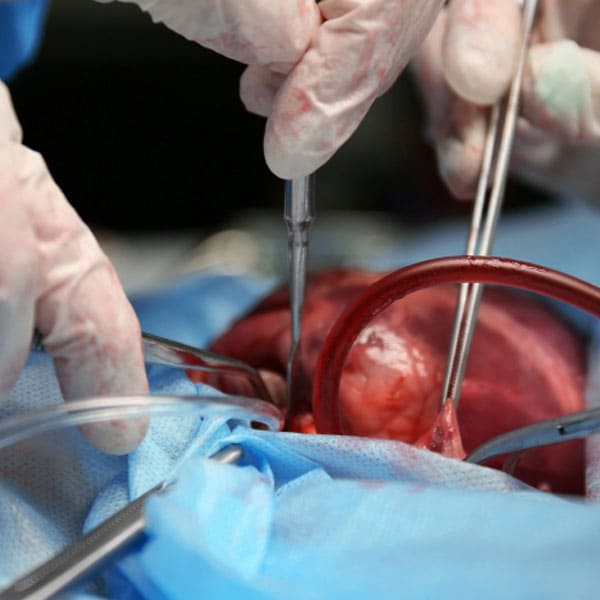 Trasplante-renal